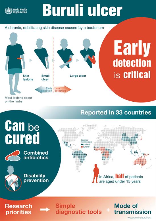 Buruli-ulcer-infographic